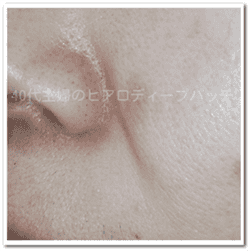ヒアロディープパッチ